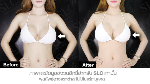 subglandular breast augmentation photos Subglandular breast augmentation photos